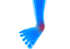 Medial Ankle Instability